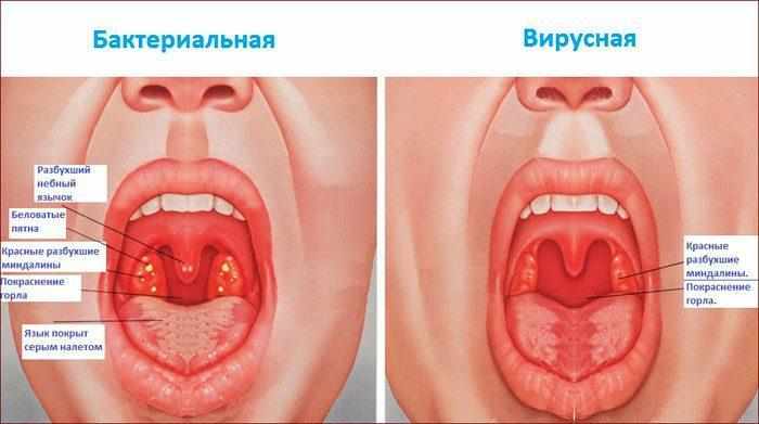 Отличия вирусной и бактериальной ангины