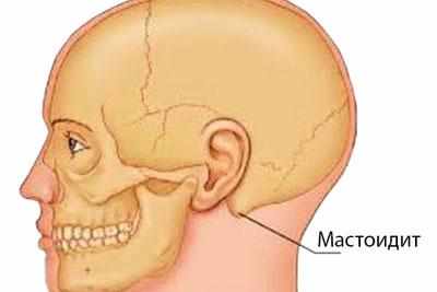 Локализация воспаления при мастоидите