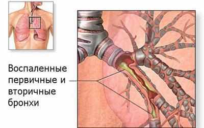 Воспаление в бронхах