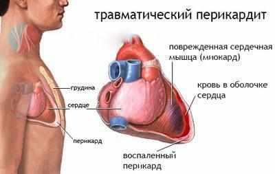 Травматический перикардит