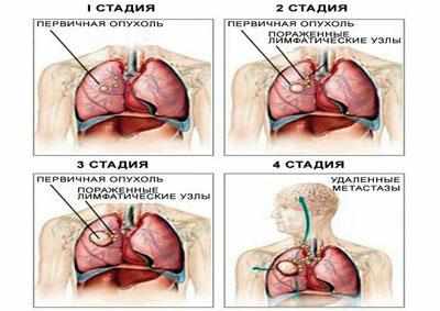 Стадии аденокарциномы лёгкого