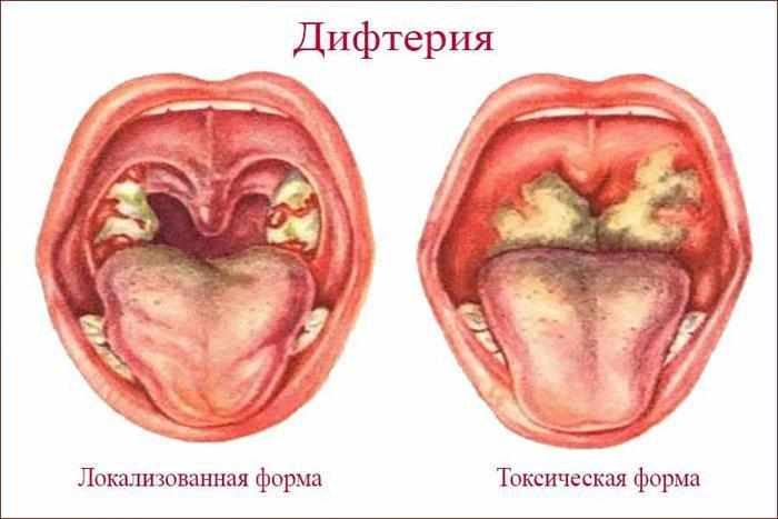 Симптомы дифтерии