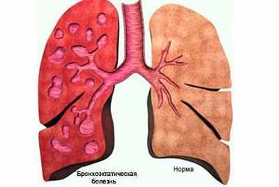 Проявление бронхоэктатической болезни