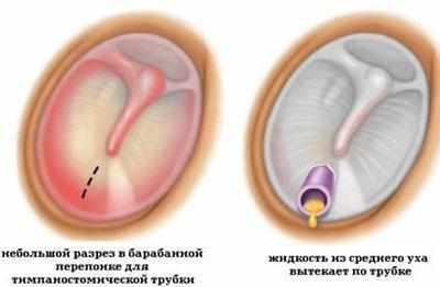 Операция миринготомия