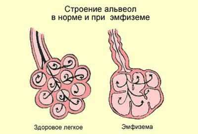 Проявление эмфиземы