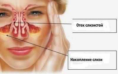 Симптомы ринита