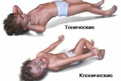 Судороги у ребенка