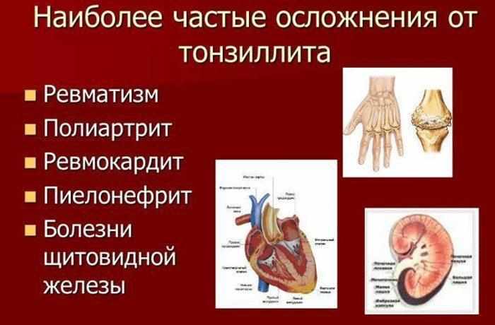 Осложнения от тонзиллита