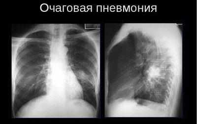 Очаговая пневмония