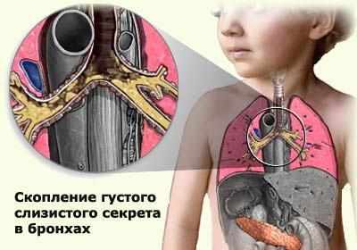 Проявление муковисцидоза