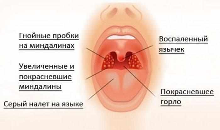 Симптомы ангины