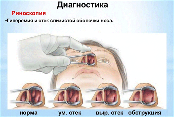 принцип риноскопии
