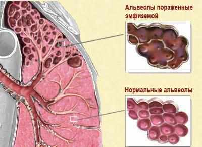 Эмфизема легких