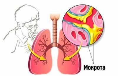Отхождение мокроты