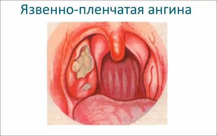 Признаки язвенно-плёночного тонзиллита