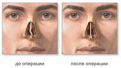 До и после септопластики