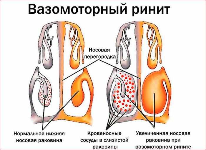 Вазомоторный ринит
