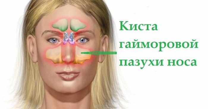 Киста гайморовой пазухи носа