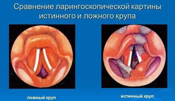 Голосовые связки при крупе