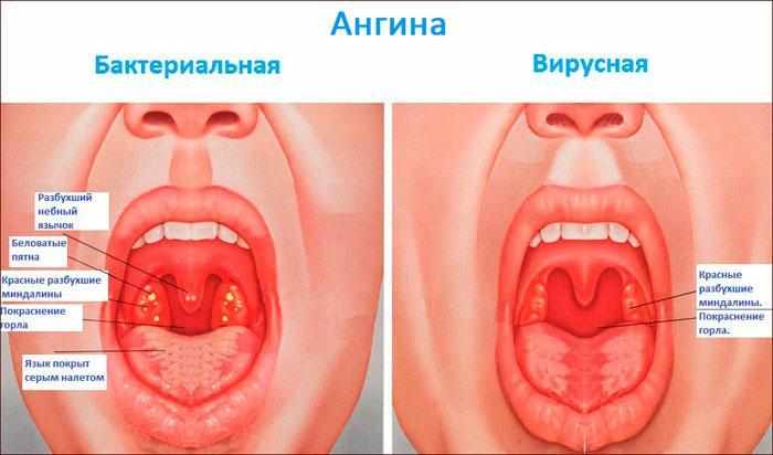 симптомы и виды ангины