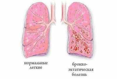 Бронхоэктаническая болезнь