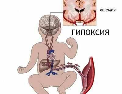 Гипоксия плода