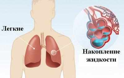 Накопление жидкости в легких