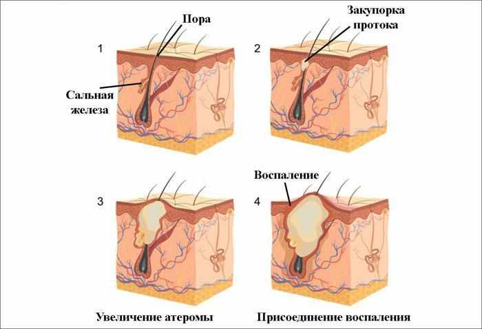 строение атеромы