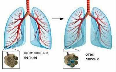 Отек легкого