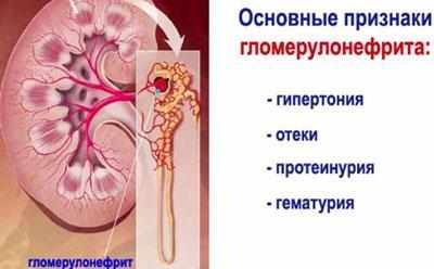 Признаки гломерулонефрита