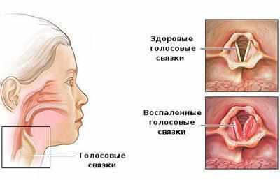 Проявление ларингита