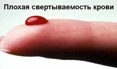 Плохая свертываемость крови