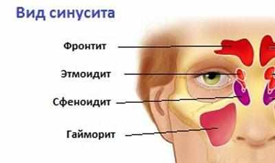 Виды синусита