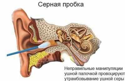 Серная пробка в ухе