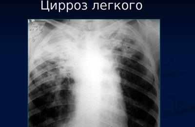 Цирроз легкого