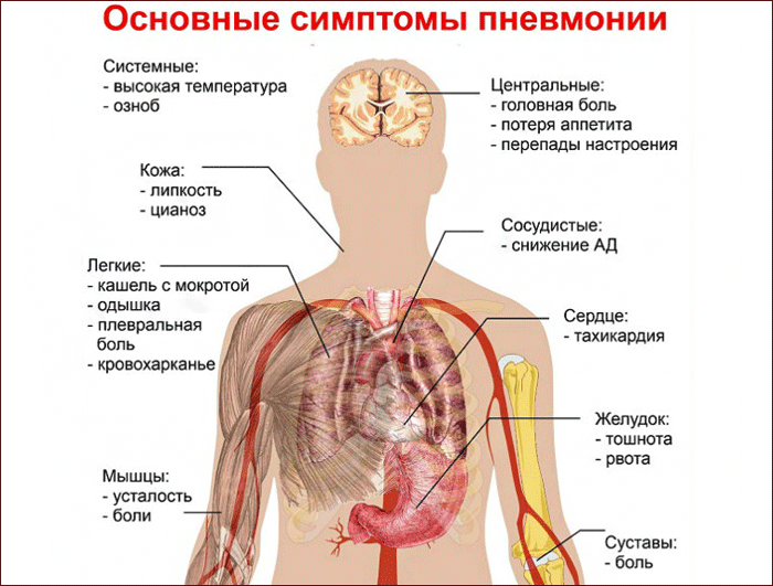 основные симптомы пневмонии