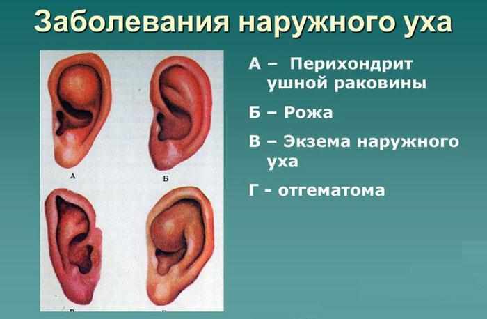 Заболевания наружного уха
