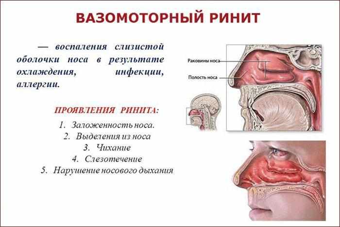 симптоматика ринита
