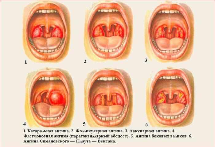 Виды ангины
