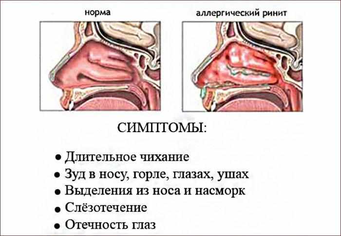 Симптомы аллергического ринита