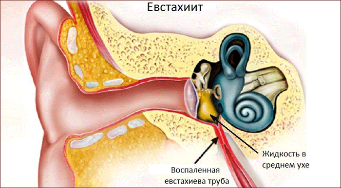 симптоматика евстахиита