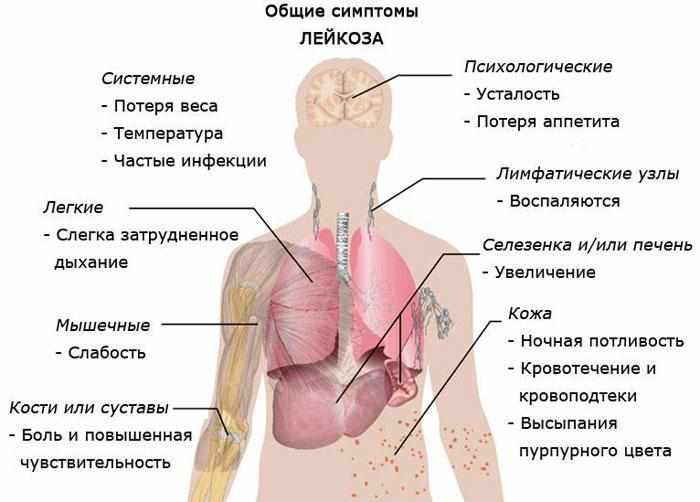 Симптомы лейкоза