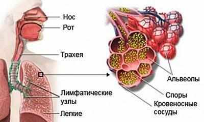 Бронхопульмональный аспергиллез
