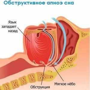 Ночное апноэ