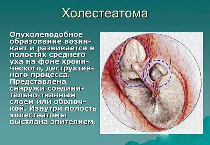 Что такое Холестеатома.