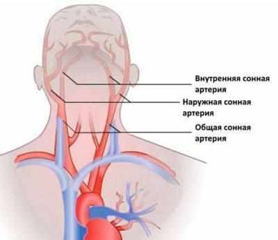 Внутренняя сонная артерия, проходящая через полость среднего уха