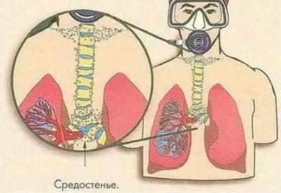 Подкожная эмфизема