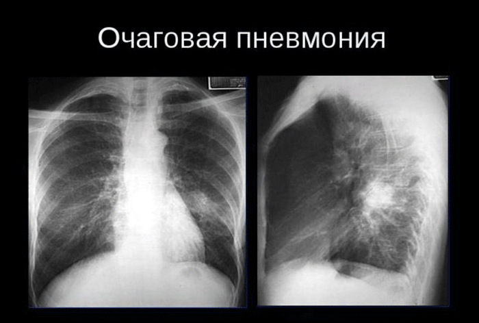 Рентгенологическая картина пневмонии