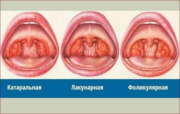 Виды ангины