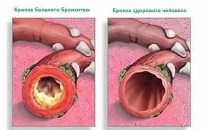 Мокрота при бронхите